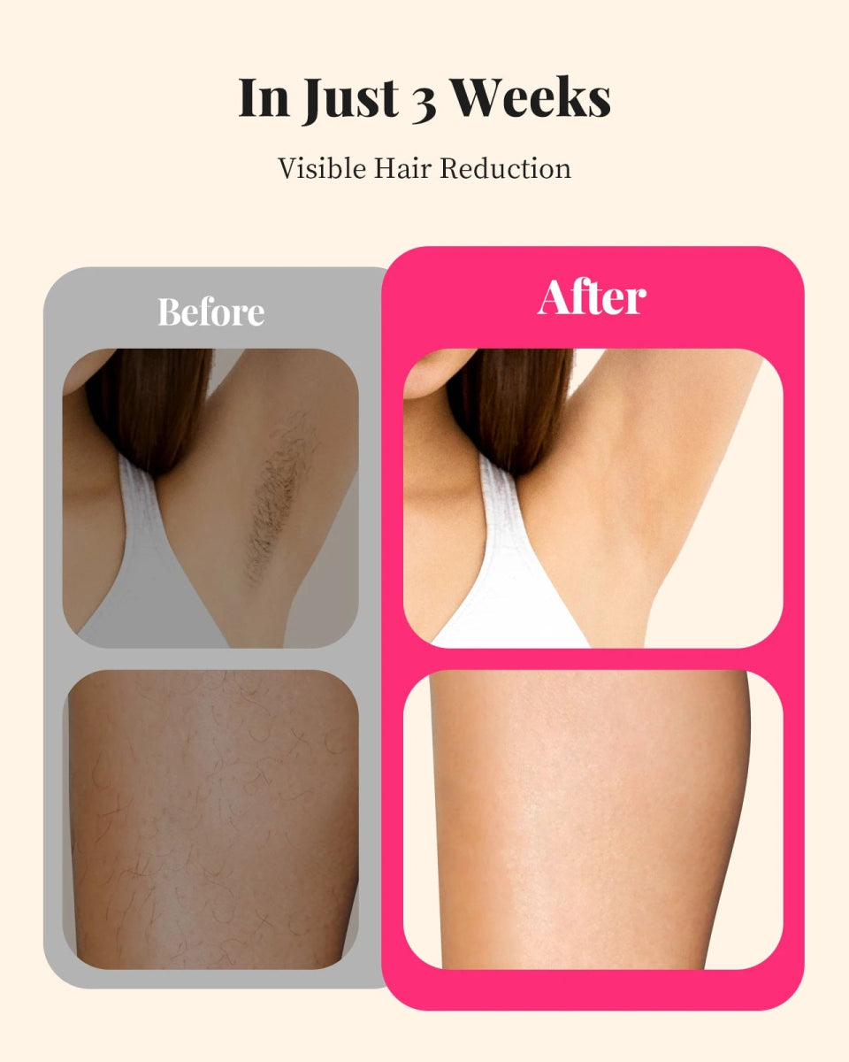 IPL Laser Hair Removal Device – TikTok’s Viral At-Home Hair Removal Solution!