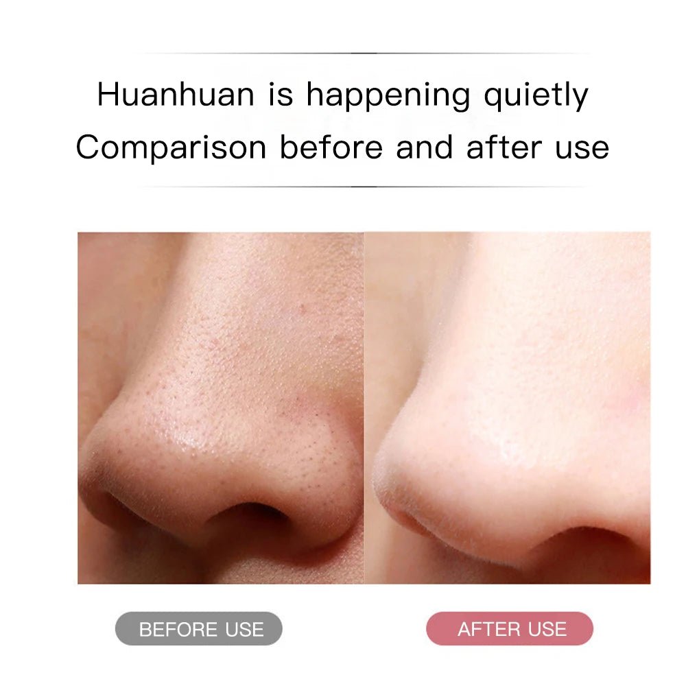 Ultrasonic Skin Scrubber | Deep Pore Cleaner & Blackhead Remover – At - Home Spa Exfoliation